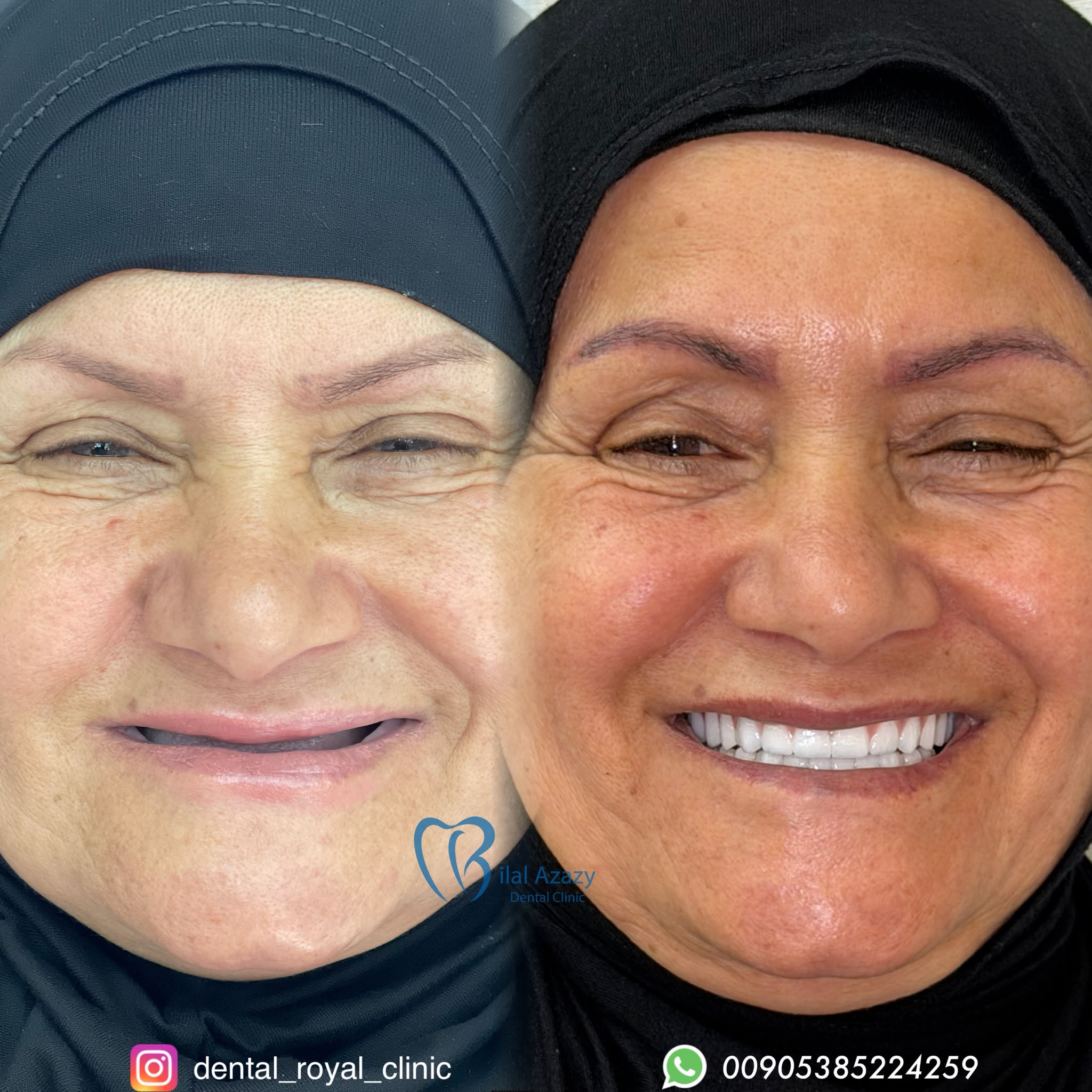 تلبيسات زيركون كاملة — النتيجة النهائية